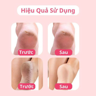 Máy Chà Gót Chân Loại Tốt: Sự Lựa Chọn Đa Năng với Sạc Điện Mẫu Mới