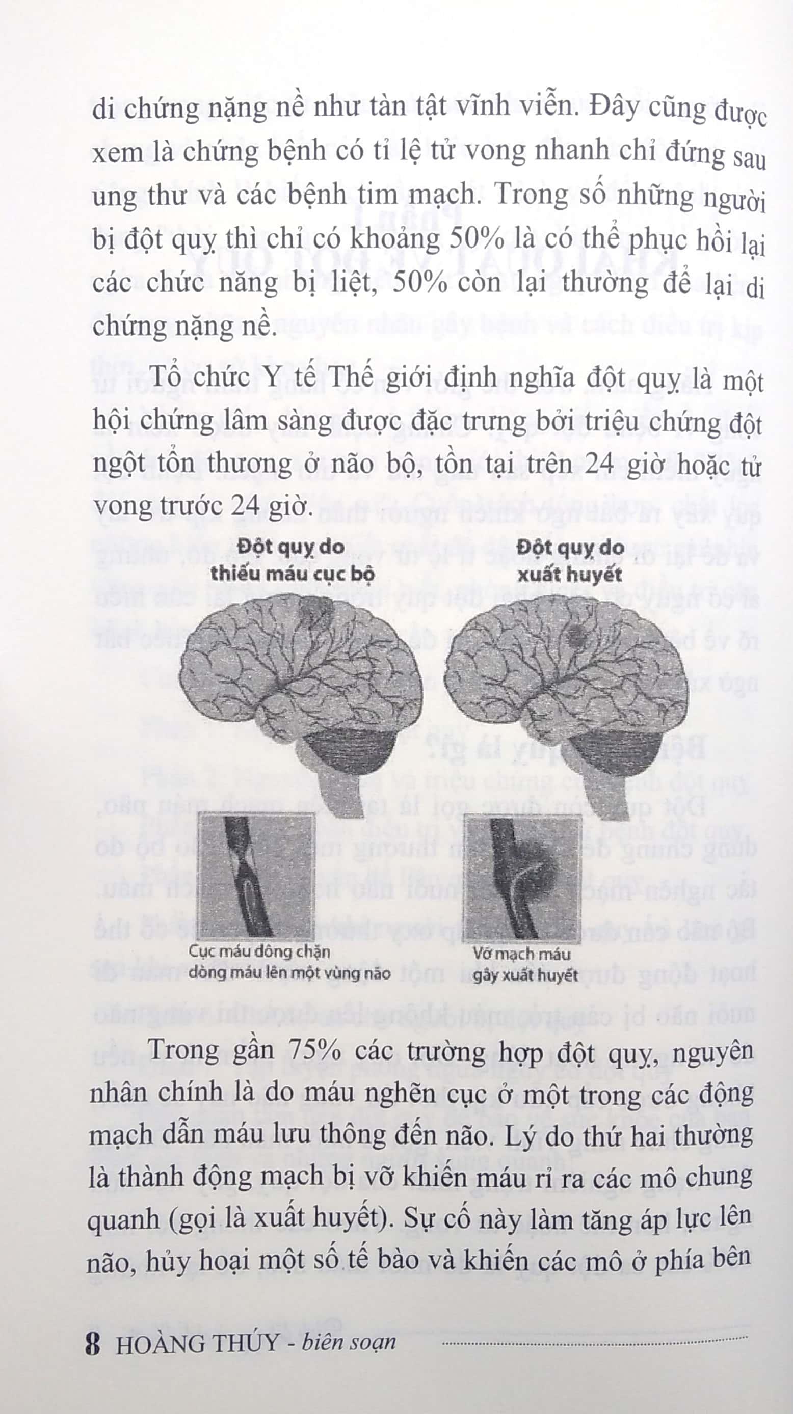 Bệnh Đột Quỵ Và Cách Điều Trị
