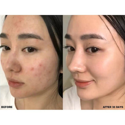 Sữa Rửa Mặt Neem Ngừa Mụn Trứng Cá Himalaya Herbals (150ml)