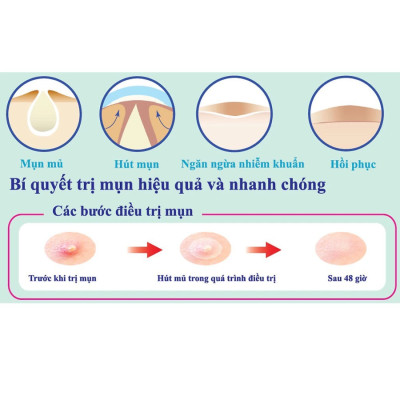 Combo 5 Miếng Dán hỗ trợ điều trị Mụn Mayancare 12 Miếng (1.0cm)