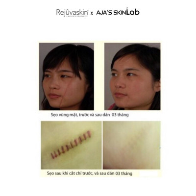 Miếng dán ngăn ngừa, nén sẹo lồi Scar FX 3.75x7.5cm REJUVASKIN - AJA