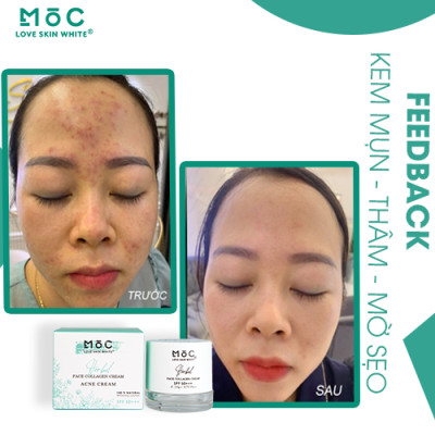 KEM NGỪA MỤN THÂM - MỜ SẸO - COLLAGEN /20G - MỘC