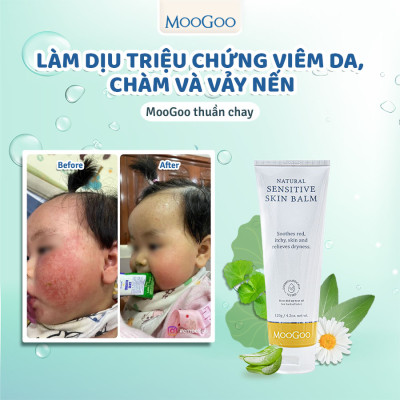 Kem bôi viêm da cơ địa, vảy nến, chàm sữa em bé, chiết xuất rau má MooGoo