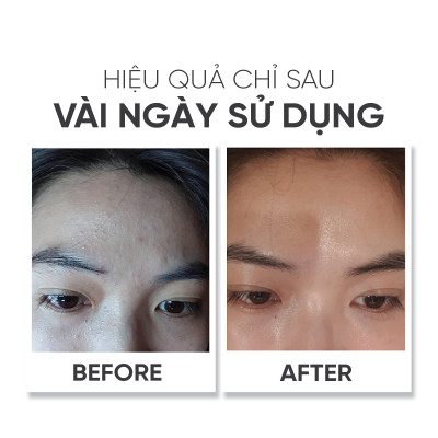 Kem dưỡng đêm dành cho da mụn, giảm thâm mụn, mờ sẹo, sáng da Lá House Acne Control Night Cream 10ml/30ml