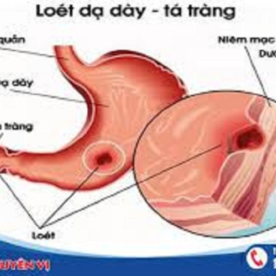 CHÈ DÂY RỪNG NGUYÊN CHẤT MẸ KEN (1kg)